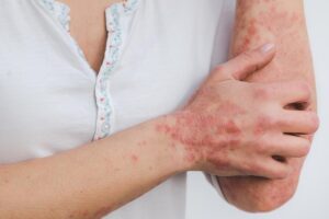 Goodbye Summer – Hello Psoriasis?